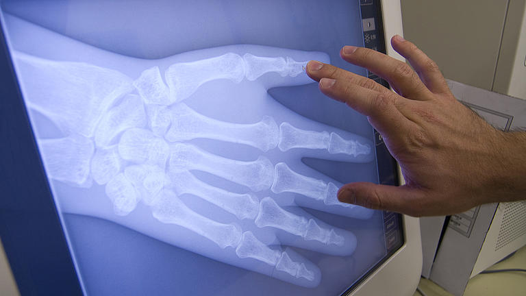 Röntgenbild einer rechten Hand auf einem Computerbildschirm. Eine Männerhand tippt auf den Bildschirm.