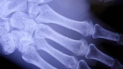 Nahaufnahme eines Röntgenbildes eine rechten Hand. Die Fingerknochen sind erkennbar.